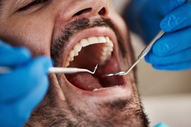 Best Emergency Tooth Extraction in Mshall, AR