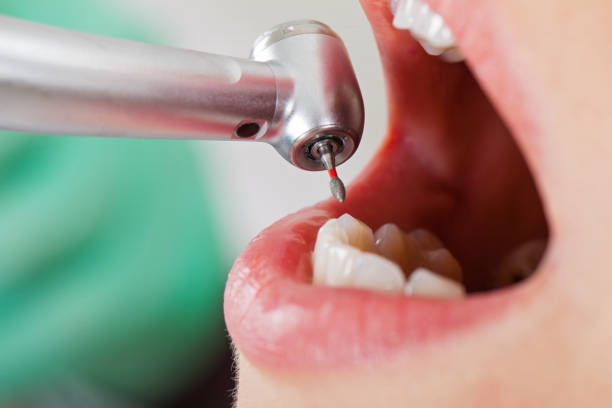 Best Emergency Root Canal Treatment in Mshall, AR